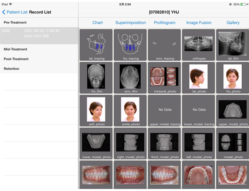 Шүдний гажиг заслын эмчилгээ оношилгоо гэж юу вэ ?